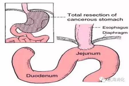 鑳冨垏闄ゆ伅鑲夊悗12灏忔椂楗,鑳冭偁鎭倝鍒囬櫎鍚庝竴鍛ㄥ悗楗