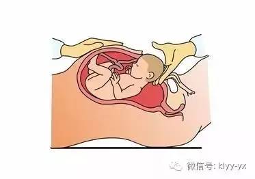 产后防治知识大全,预防产后出血护理方式分析