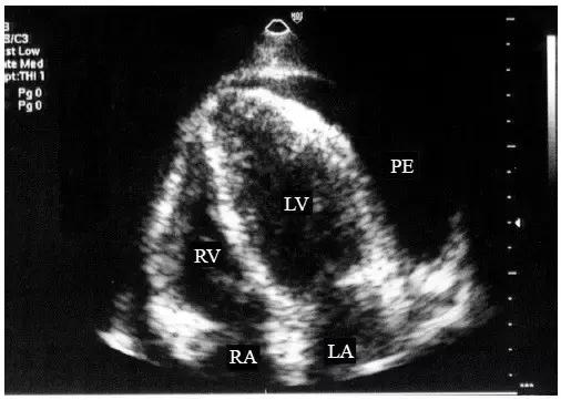 超声诊断心包腔积液,心包积液的超声诊断与鉴别