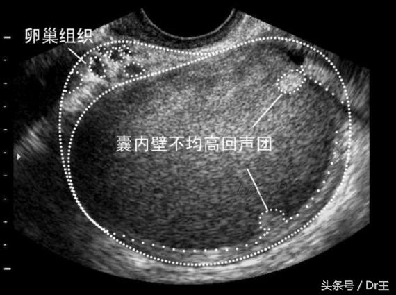 胀气、下背痛、反胃、骨盆疼痛，有这些症状的女性要当心！