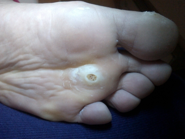 治鸡眼的十大民间偏方,鸡眼图片大全及治疗方法