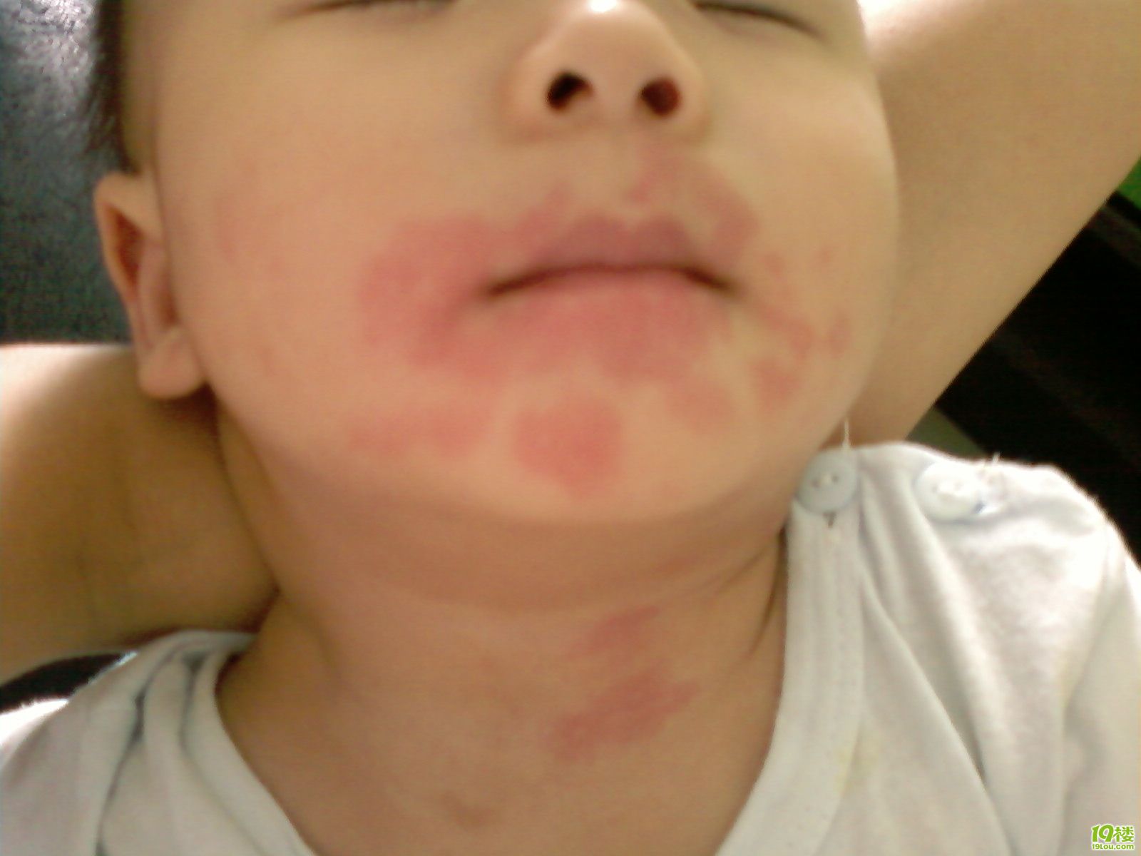 孩子食物过敏需要吃药吗,孩子食物过敏要不要去幼儿园