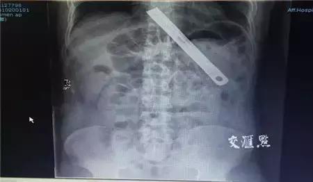 X光片里的体内异物，简直大开眼界