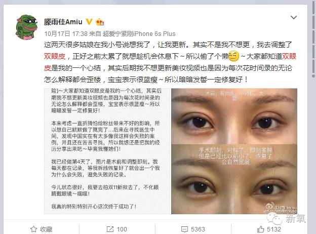 网红做双眼皮变化,整双眼皮成功的网红