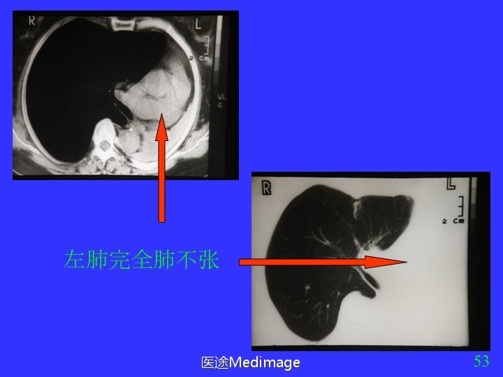 胸部ct扫描双肺未见明显异常,胸部ct报告心脏不大正常吗