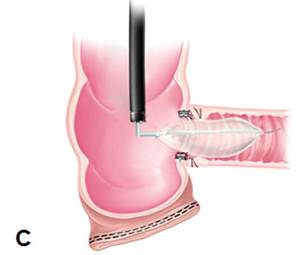 克罗恩病内镜严重程度指数,克罗恩病内镜检查是怎么样的