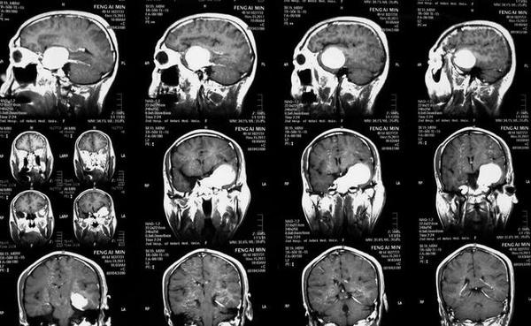 海绵窦海绵状血管瘤,海绵窦区海绵状血管瘤发病年龄