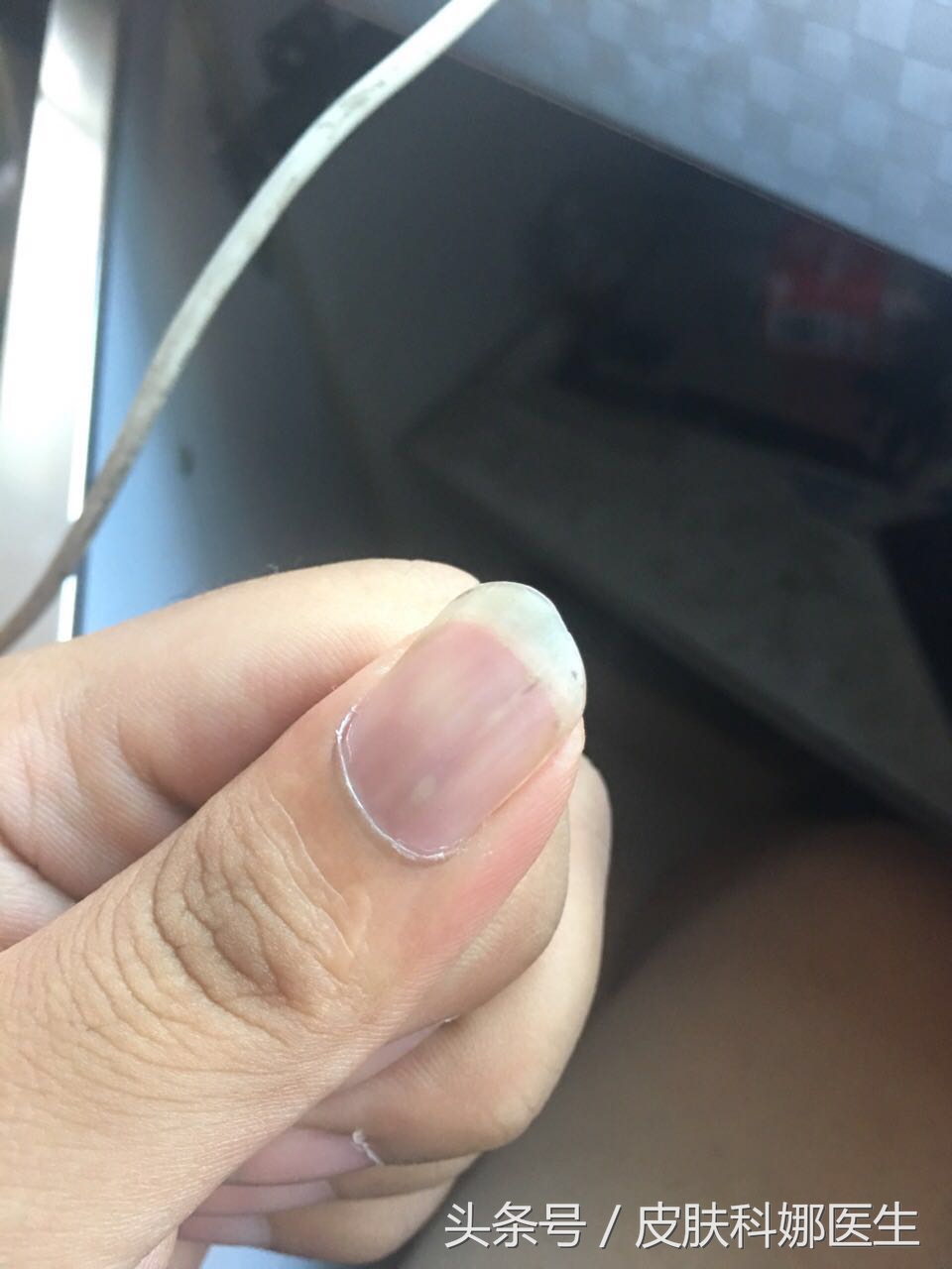 指甲里扎了个刺没重视一年后会痛,指甲里像扎了竹签一样痛什么原因