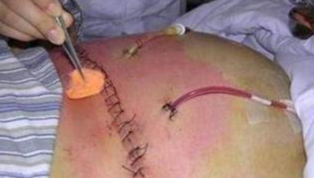 剖腹产的痛只有剖腹产的人才知道,你以为的剖腹产实际的剖腹产