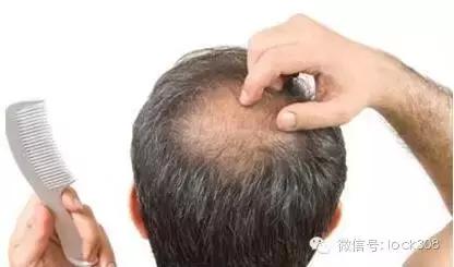 前额头脂溢性脱发最佳治疗方法,头发中间秃了怎么回事脂溢性脱发