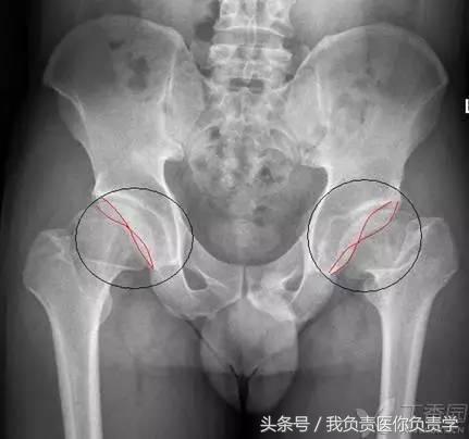 正常骨盆x线片详解,骨科医生只看报告单