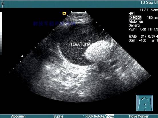 孕妈妈核磁共振检查多久出报告,孕妈妈做检查