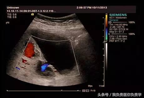 楂樻墜杩涢樁鑵拌吂璁粌,鑳嗗泭缁撶煶绌垮瓟鐥囩姸