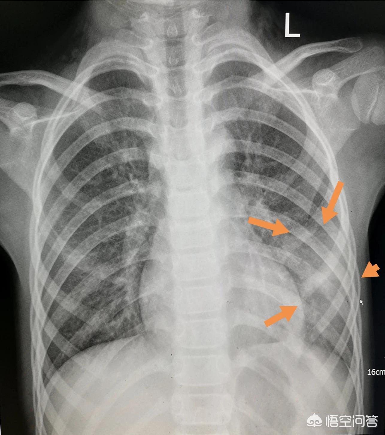 孩子得了肺炎一定要输液吗？医生：请避开这9个认知误区