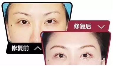 埋线双眼皮失败怎样恢复,埋线双眼皮做失败后怎么修复