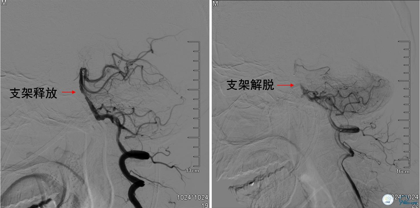 中医治疗基底动脉闭塞,基底动脉尖综合征病例分享