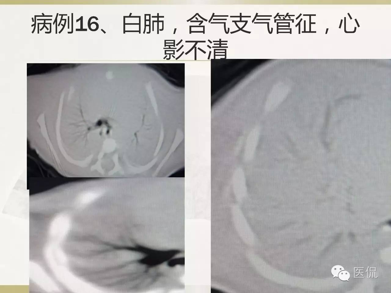「资料丨医看分享」南边老师肺部群：新生儿透明膜病（HMD）医学影像