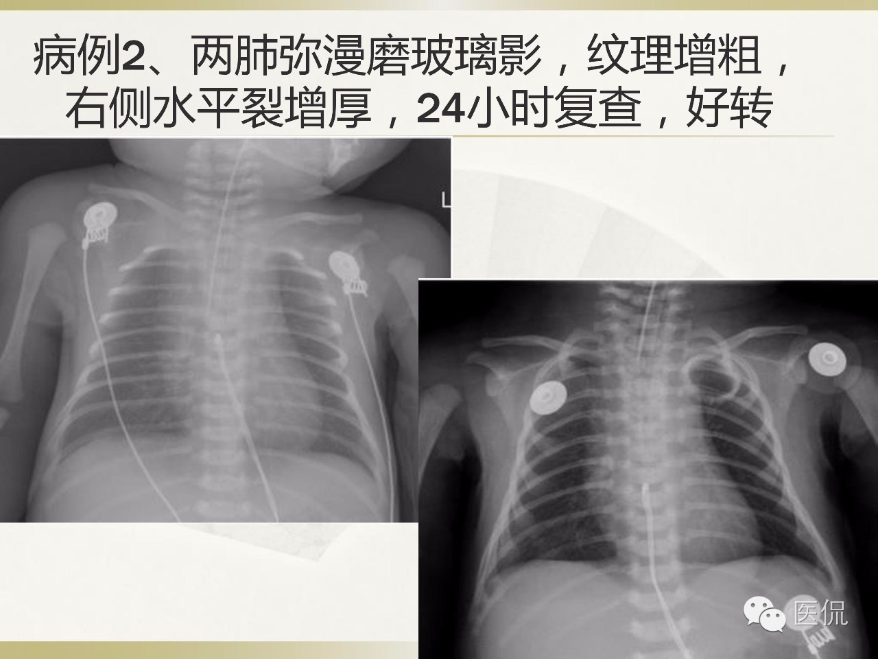 「资料丨医看分享」南边老师肺部群：新生儿透明膜病（HMD）医学影像