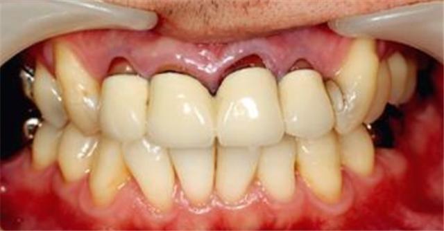 牙龈牙齿不好怎么办,牙龈不好用什么药恢复得好