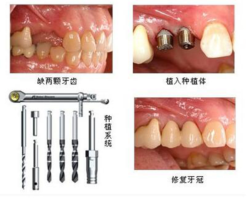 门牙松动严重拔掉能种植牙吗,门牙掉了可以通过正畸矫正吗