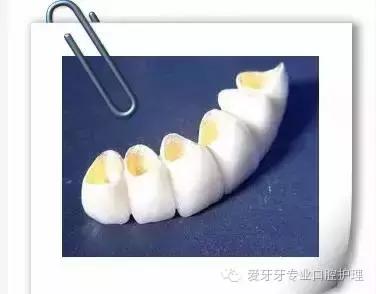 烤瓷牙和全瓷牙的区别和价格,贵的烤瓷牙和便宜的有区别吗