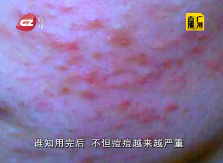 抗生素加脚气膏变治痘神药，女孩网络抢购致脸部红肿
