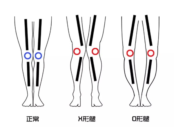 如何矫正o型腿让腿变直,男士腿型矫正十种让腿变直的方法