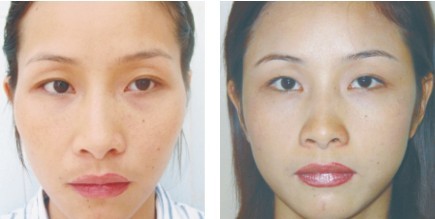 为什么玻尿酸丰唇没有任何效果,玻尿酸丰太阳穴有点压在眼皮