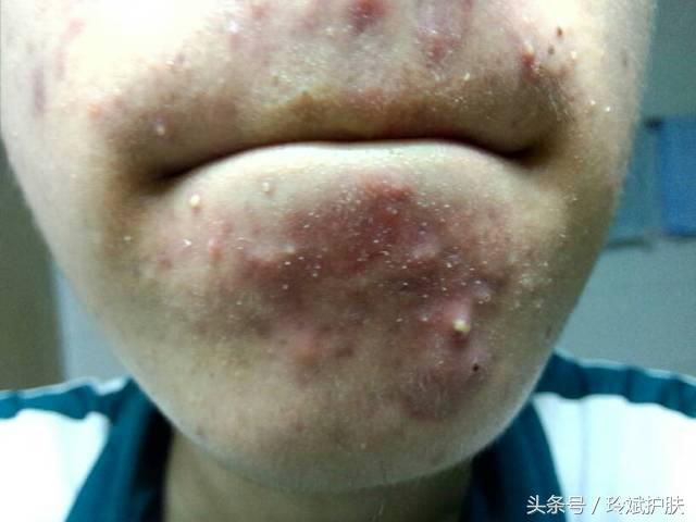 下巴两边长痘痘的正确消除方法,下巴老长痘痘怎么调理啊