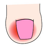 指甲出现白点与竖纹是怎么回事,指甲出现白点什么原因