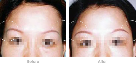 为什么玻尿酸丰唇没有任何效果,玻尿酸丰太阳穴有点压在眼皮