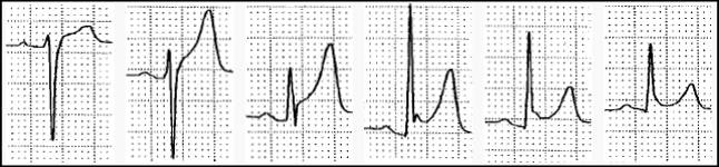 心电图st段呈j点型抬高是什么意思,心电图st段抬高一定是心梗吗