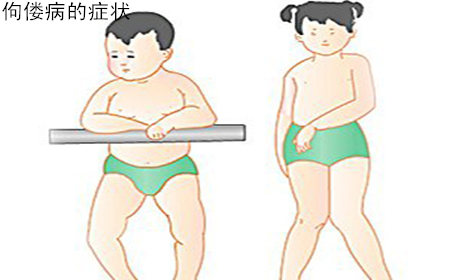 宝宝有严重佝偻病怎么办,宝宝佝偻病严重了怎么办