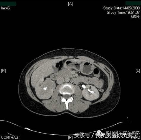 57岁女性出现一次无痛血尿,女性42岁全程无痛性肉眼血尿
