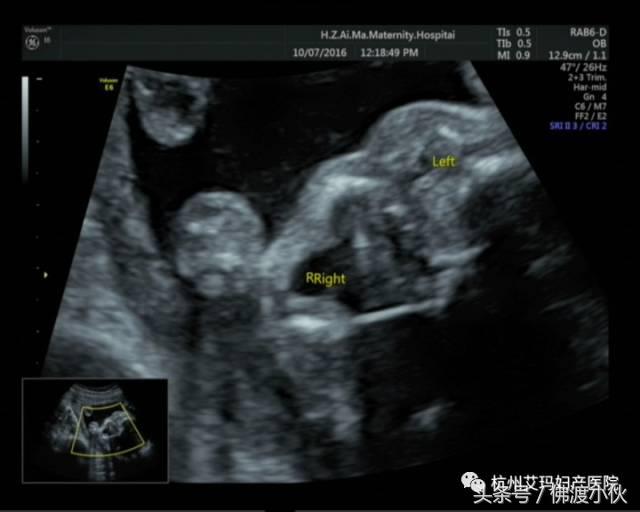 “借我,借我一双慧眼吧”——胎儿眼畸形