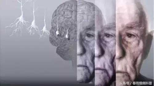 血管性痴呆是什么意思,血管性痴呆寿命是几年