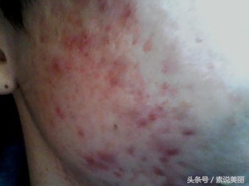 如果脸上涂了激素产品后果怎么样,脸上用了含激素的产品应该怎么办