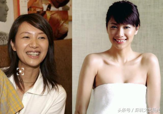 林允整牙效果怎么样,林允整牙后变化图片