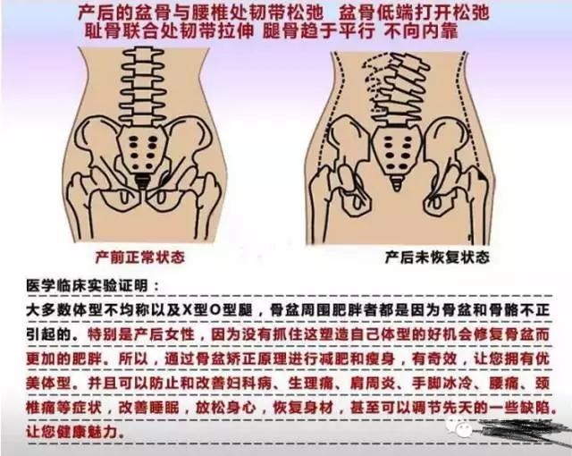 骨盆矫正手法,骨盆矫正手法不正确会歪吗