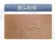 如何有效避免或减少青春痘的出现,避免青春痘误区彻底治疗青春痘