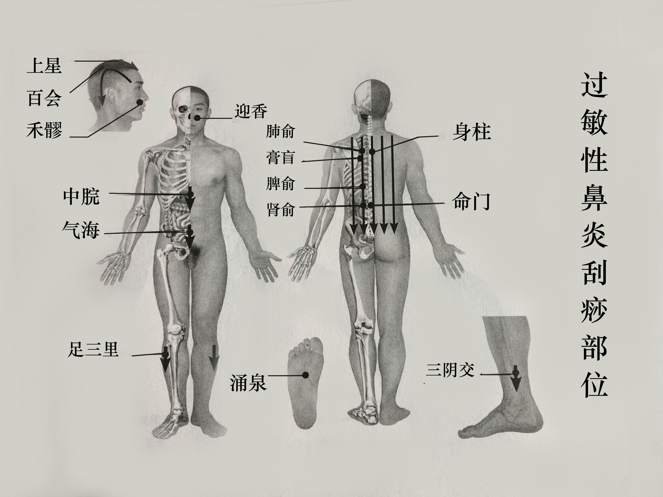 过敏性鼻炎刮痧艾灸疗法,鼻炎咽炎刮痧刮哪里