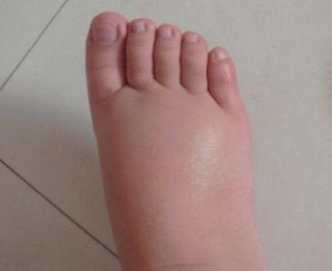 孕妇脚肿是怎么处理,孕妇脚肿是怎么回事中医解答