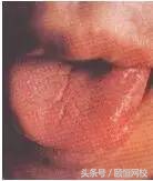 中医舌诊图谱100例,靠谱中医史上最全高清舌诊图谱