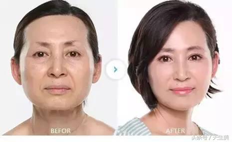 超声刀怎么样啊 (超声刀分享)