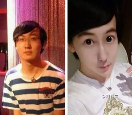 双眼皮手术韩式整形,韩国医生做幽灵手术