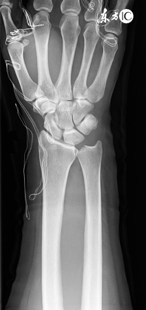 骨刺消痛液药方,治骨刺的特效药方