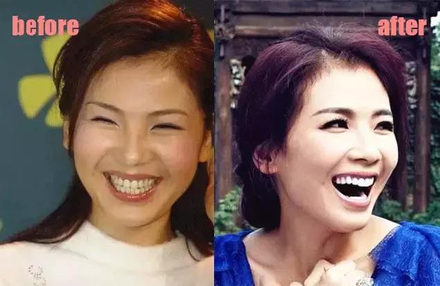 整牙=整容?看杨幂、刘涛、高圆圆为你亲身示范!