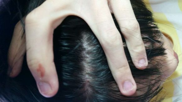 头部脂溢性皮炎,头油,头痒,头屑多,中医用1种针具扣刺