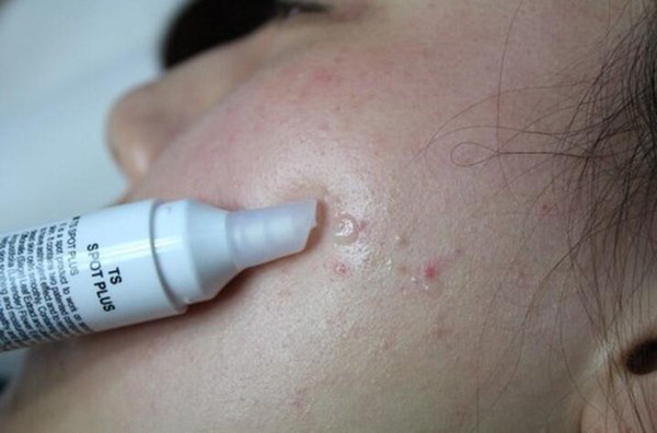 小孩鼻子周围长痘痘是什么原因,鼻子嘴唇周围长痘痘是什么原因