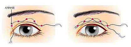 做埋线双眼皮以后不拆线可以吗,埋线双眼皮不拆线有危害吗
